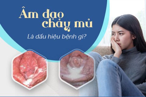 Âm đạo chảy mủ là dấu hiệu bị gì