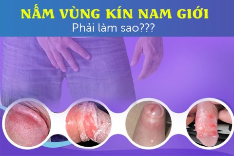 Bị nấm vùng kín nam giới phải làm sao