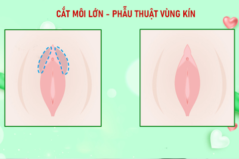 CAT-MOI-LON-PHAU-THUAT-VUNG-KIN
