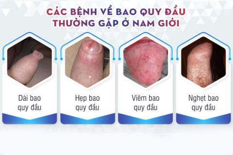 Các bệnh bao quy đầu ở nam giới