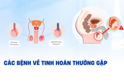 Các bệnh tinh hoàn thường gặp ở nam giới