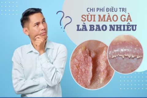 Đốt sùi mào gà và chi phí bao nhiêu