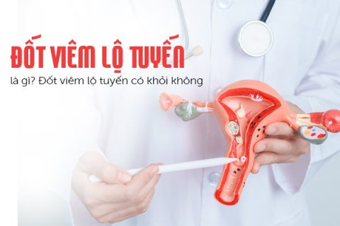 Đốt viêm lộ tuyến là gì Đốt viêm lộ tuyến có khỏi không