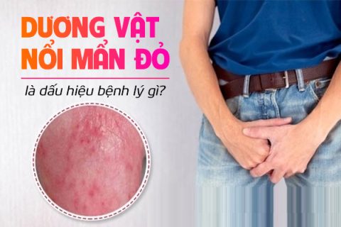 Dương vật nổi mẩn đỏ là dấu hiệu bệnh lý gì