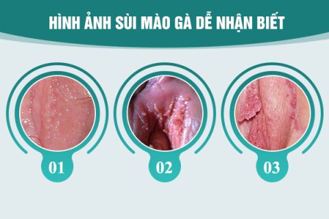 Hình ảnh sùi mào gà dễ nhận biết nhất