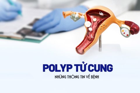 Những thông tin về bệnh polyp tử cung