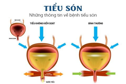 Những thông tin về bệnh tiểu són