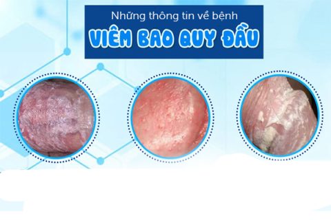 Những thông tin về bệnh viêm bao quy đầu
