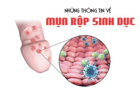 Những thông tin về mụn rộp sinh dục ở nam