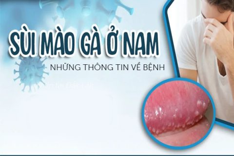 Những thông tin về sùi mào gà ở nam