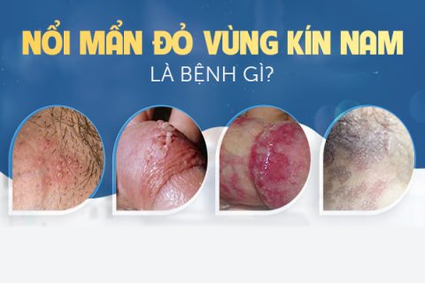 Nổi mẩn đỏ vùng kín nam là bị bệnh gì