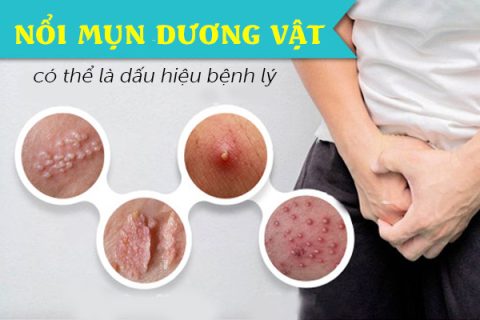 Nổi mụn dương vật có thể là dấu hiệu bị bệnh lý