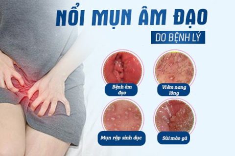 Nổi mụn ở âm đạo là do bệnh gì