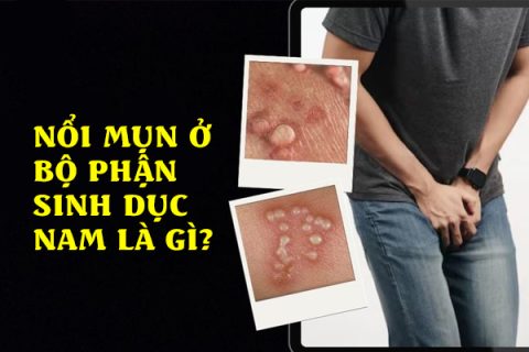Nổi mụn ở bộ phận sinh dục nam là gì