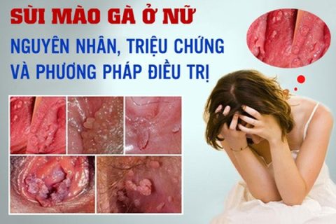 Sùi mào gà Dấu hiệu nguyên nhân và cách điều trị hiệu quả