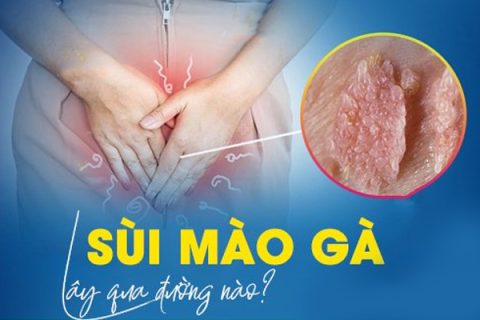 Sùi mào gà lây qua đường nào