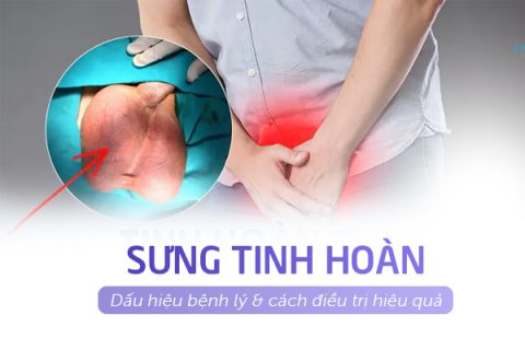 Sưng tinh hoàn Dấu hiệu bệnh lý & cách điều trị hiệu quả