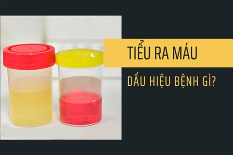Tiểu ra máu là dấu hiệu bị bệnh gì