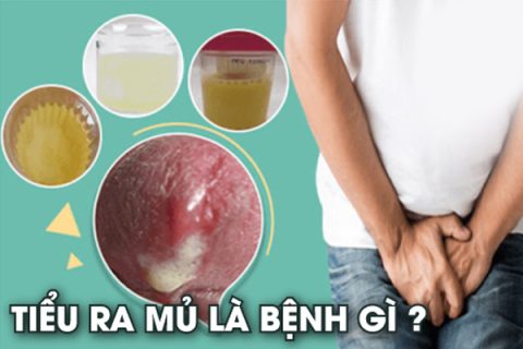 Tiểu ra mủ là dấu hiệu của bệnh lý gì