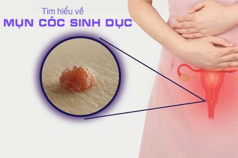 Tìm hiểu về bệnh mụn cóc sinh dục