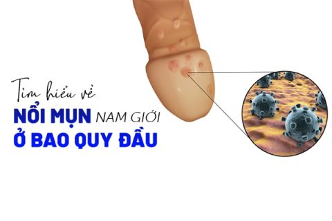 Tìm hiểu về nổi mụn bao quy đầu ở nam giới