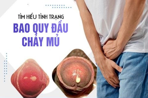 Tìm hiểu về tình trạng bao quy đầu chảy mủ