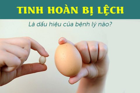 Tinh hoàn bị lệch là dấu hiệu của bệnh lý nào