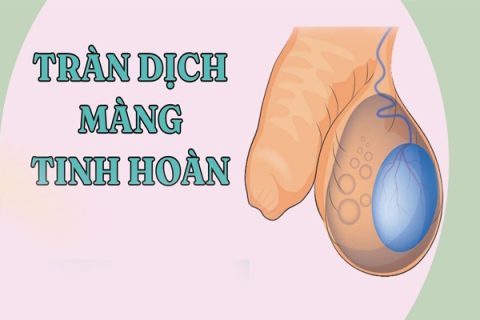 Tràn dịch màng tinh hoàn ở nam giới