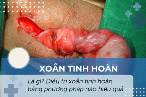 Xoắn tinh hoàn là gì Điều trị xoắn tinh hoàn hiệu quả