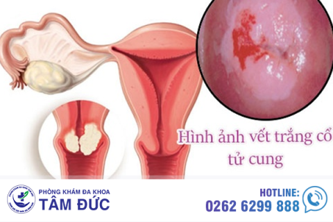 hinh-anh-vet-trang-o-co-tu-cung